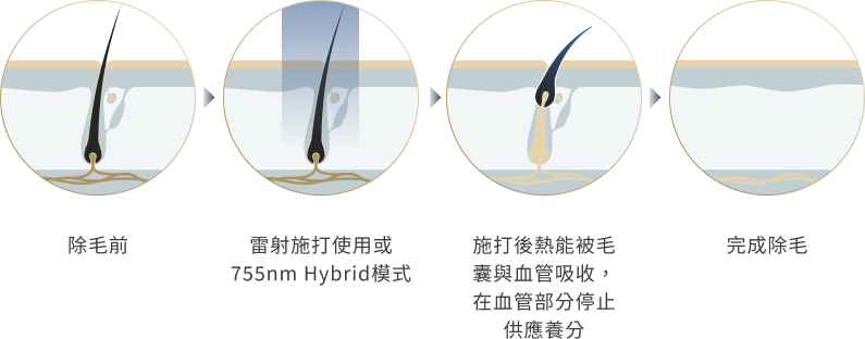 除毛原理